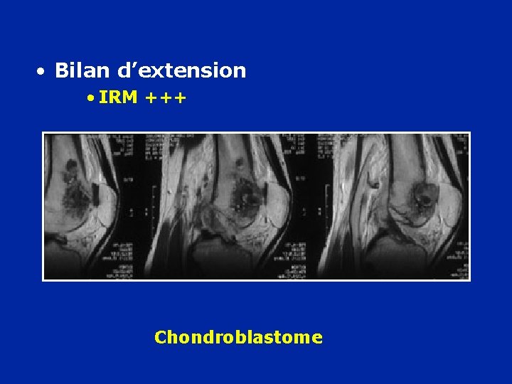  • Bilan d’extension • IRM +++ Chondroblastome 