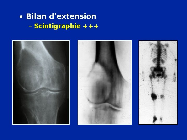  • Bilan d’extension – Scintigraphie +++ 