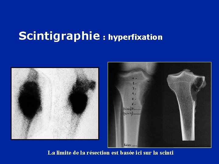 Scintigraphie : hyperfixation La limite de la résection est basée ici sur la scinti