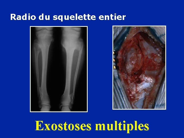 Radio du squelette entier Exostoses multiples 