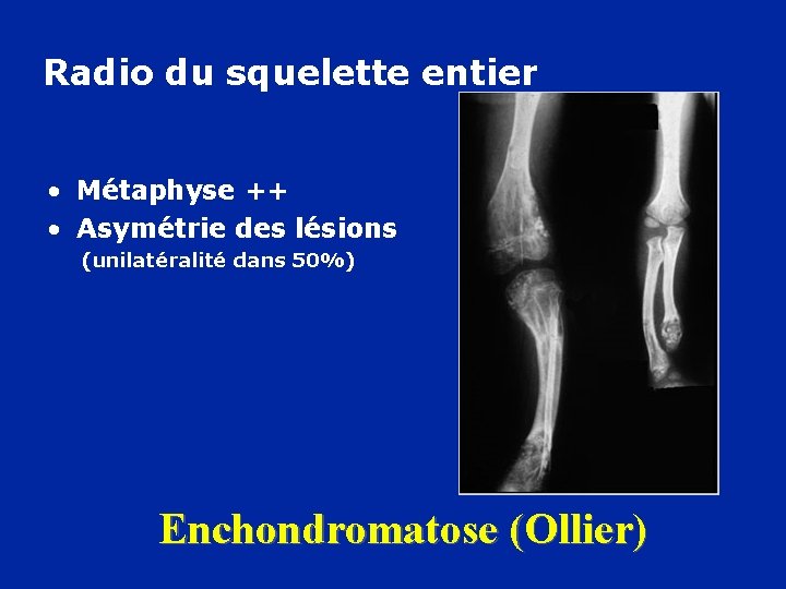 Radio du squelette entier • Métaphyse ++ • Asymétrie des lésions (unilatéralité dans 50%)