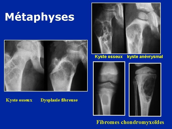 Métaphyses Kyste osseux kyste anévrysmal Dysplasie fibreuse Fibromes chondromyxoïdes 