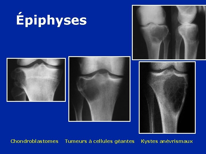 Épiphyses Chondroblastomes Tumeurs à cellules géantes Kystes anévrismaux 