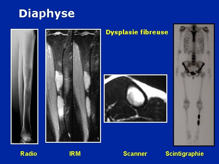Diaphyse Dysplasie fibreuse F 30 ans : Douleurs à la course Radio IRM Scanner