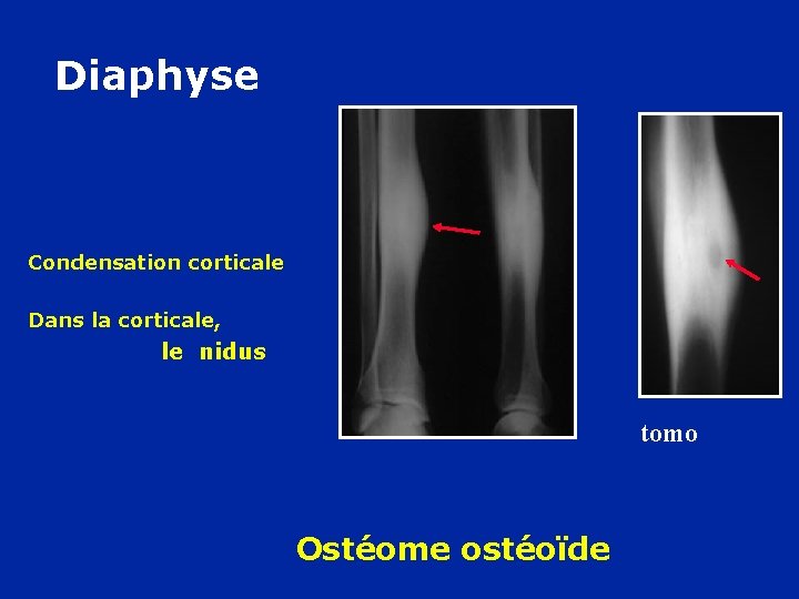 Diaphyse Condensation corticale Dans la corticale, le nidus tomo Ostéome ostéoïde 