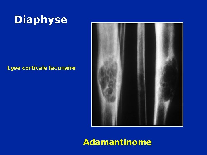 Diaphyse Lyse corticale lacunaire Adamantinome 