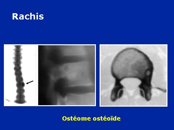 Rachis Ostéome ostéoïde 