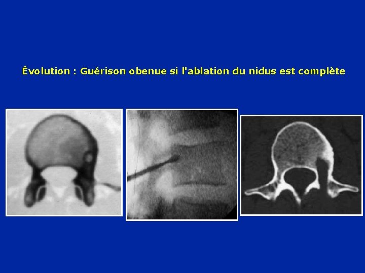 Évolution : Guérison obenue si l'ablation du nidus est complète 