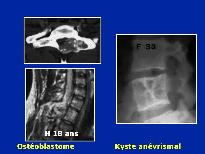 H 18 ans Ostéoblastome Kyste anévrismal 