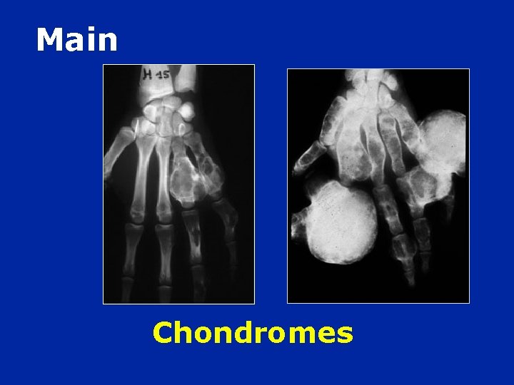 Main Chondromes 