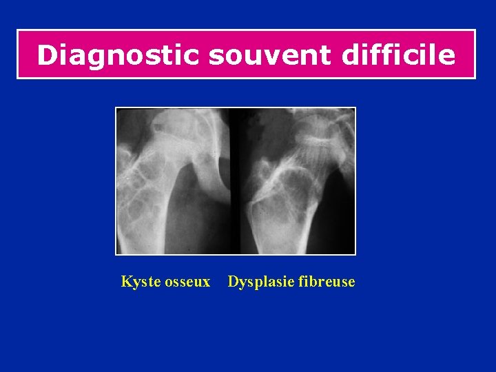 Diagnostic souvent difficile Kyste osseux Dysplasie fibreuse 