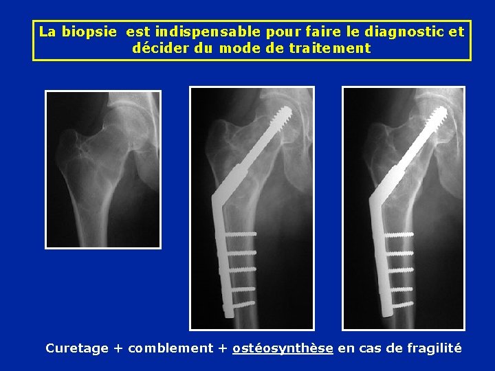 La biopsie est indispensable pour faire le diagnostic et décider du mode de traitement