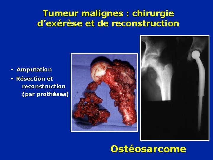 Tumeur malignes : chirurgie d’exérèse et de reconstruction - Amputation - Résection et reconstruction