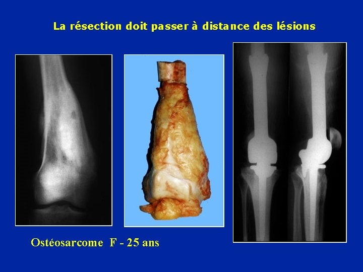 La résection doit passer à distance des lésions Ostéosarcome F - 25 ans 