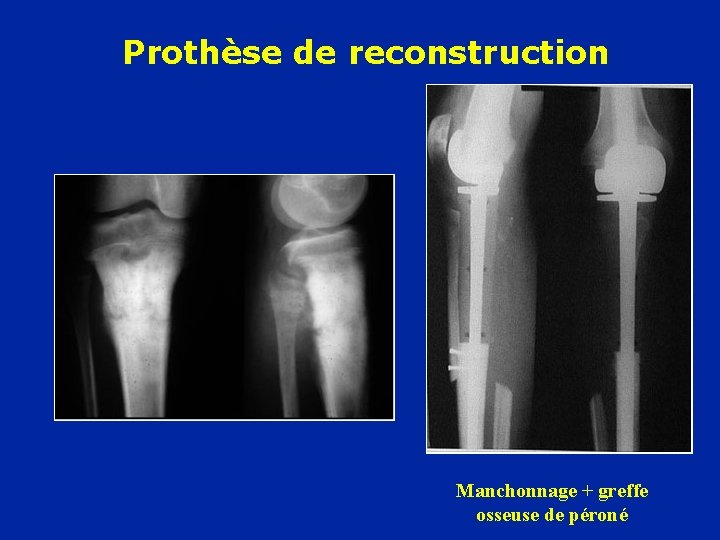 Prothèse de reconstruction Manchonnage + greffe osseuse de péroné 