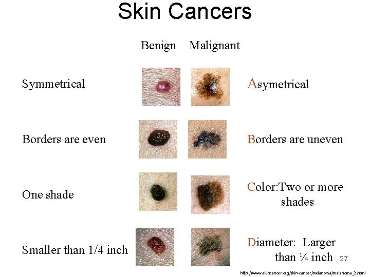 Skin Cancers Benign Malignant Symmetrical Asymetrical Borders are even Borders are uneven One shade