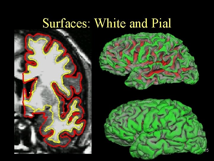 Surfaces: White and Pial 15 