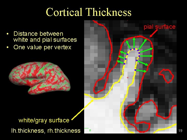 Cortical Thickness • Distance between white and pial surfaces • One value per vertex