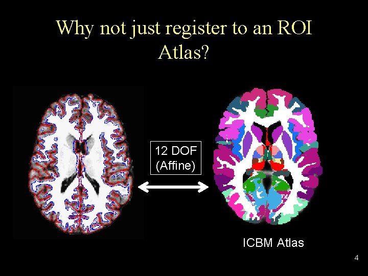 Why not just register to an ROI Atlas? 12 DOF (Affine) ICBM Atlas 4