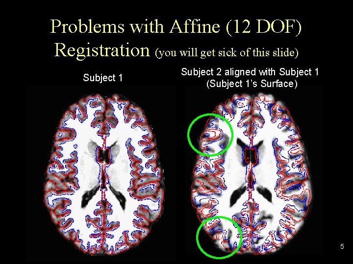 Problems with Affine (12 DOF) Registration (you will get sick of this slide) Subject