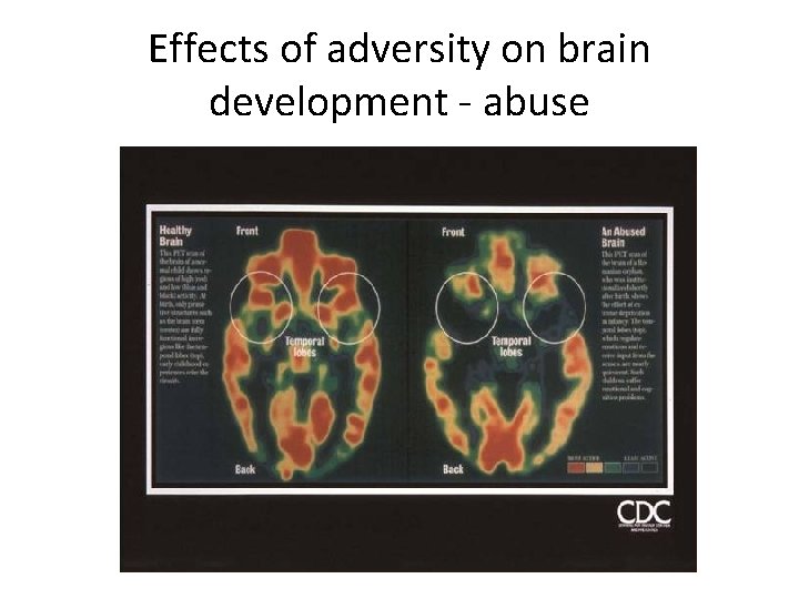 Effects of adversity on brain development - abuse 