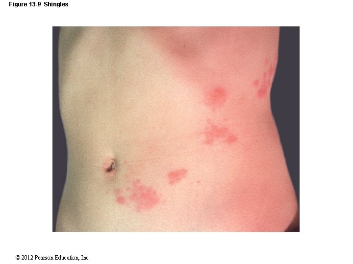 Figure 13 -9 Shingles © 2012 Pearson Education, Inc. 