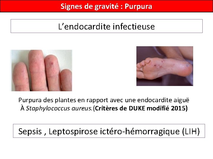 Signes de gravité : Purpura L’endocardite infectieuse Purpura des plantes en rapport avec une