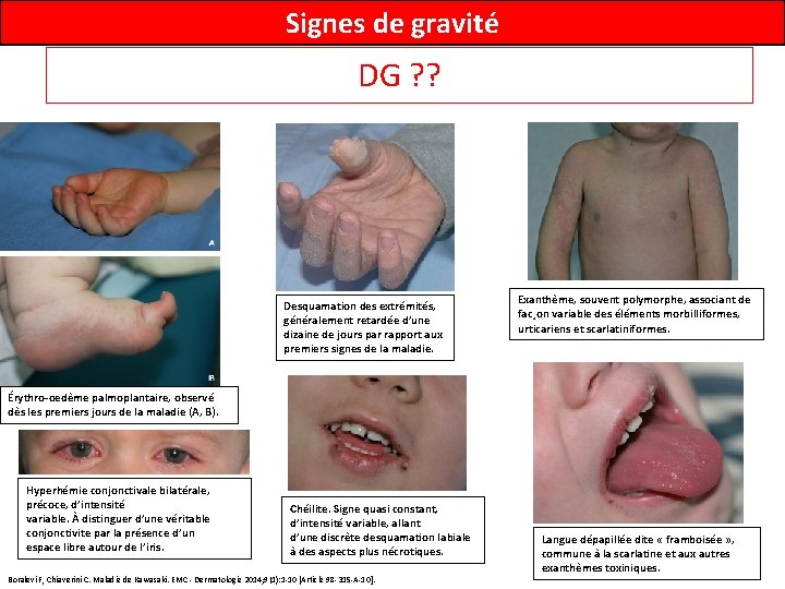 Signes de gravité DG ? ? Desquamation des extrémités, généralement retardée d’une dizaine de