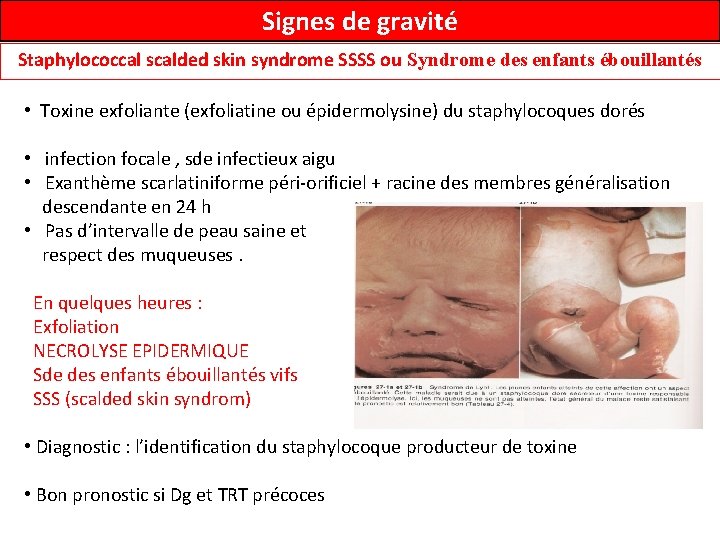 Signes de gravité Staphylococcal scalded skin syndrome SSSS ou Syndrome des enfants ébouillantés •