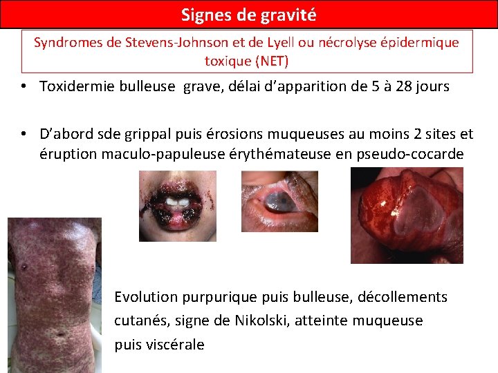 Signes de gravité Syndromes de Stevens-Johnson et de Lyell ou nécrolyse épidermique toxique (NET)