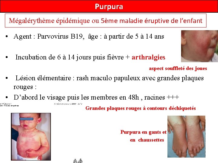 Purpura Mégalérythème épidémique ou 5ème maladie éruptive de l’enfant • Agent : Parvovirus B