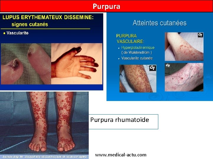 Purpura rhumatoïde www. medical-actu. com 