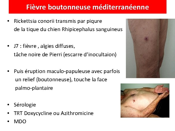 Fièvre boutonneuse méditerranéenne • Rickettsia conorii transmis par piqure de la tique du chien