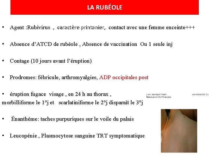 LA RUBÉOLE • Agent : Rubivirus , caractère printanier, contact avec une femme enceinte+++