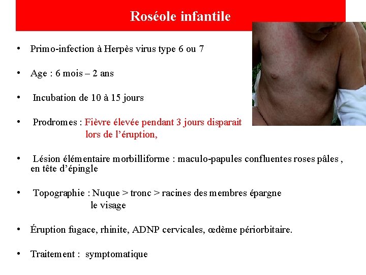 Roséole infantile • Primo-infection à Herpès virus type 6 ou 7 • Age :