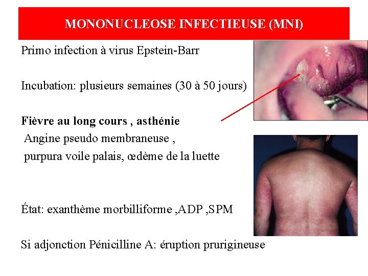 MONONUCLEOSE INFECTIEUSE (MNI) Primo infection à virus Epstein-Barr Incubation: plusieurs semaines (30 à 50