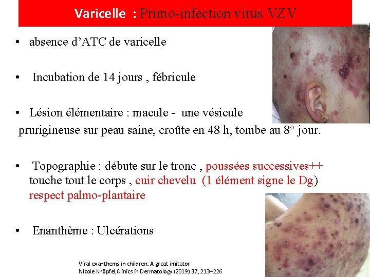 Varicelle : Primo-infection virus VZV • absence d’ATC de varicelle • Incubation de 14