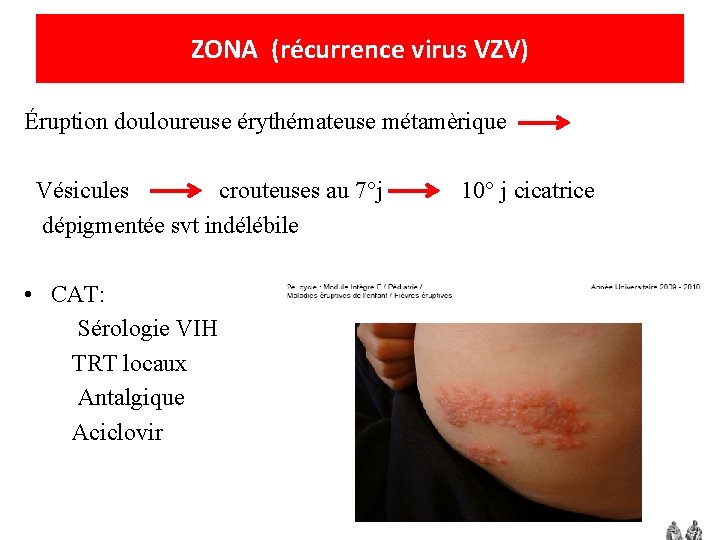 ZONA (récurrence virus VZV) Éruption douloureuse érythémateuse métamèrique Vésicules crouteuses au 7°j dépigmentée svt