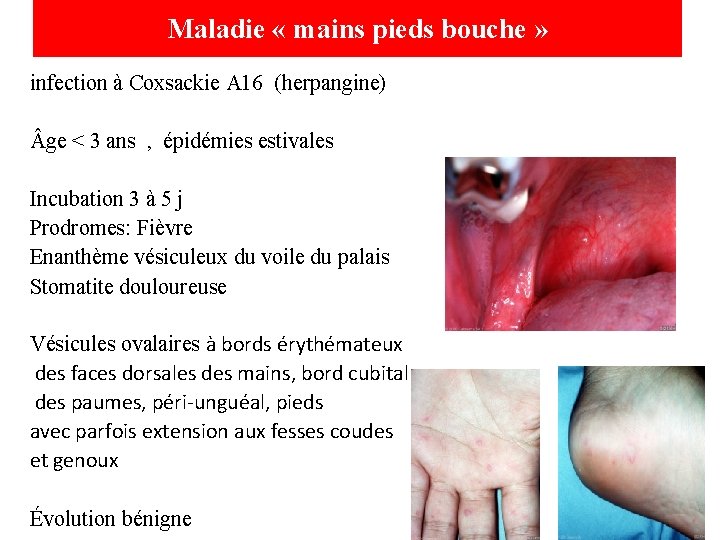 Maladie « mains pieds bouche » infection à Coxsackie A 16 (herpangine) ge <