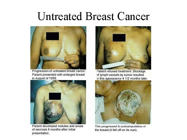 Untreated Breast Cancer Untreated Breast Cancer