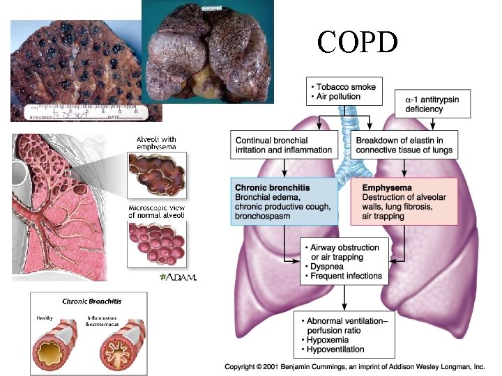 COPD COPD