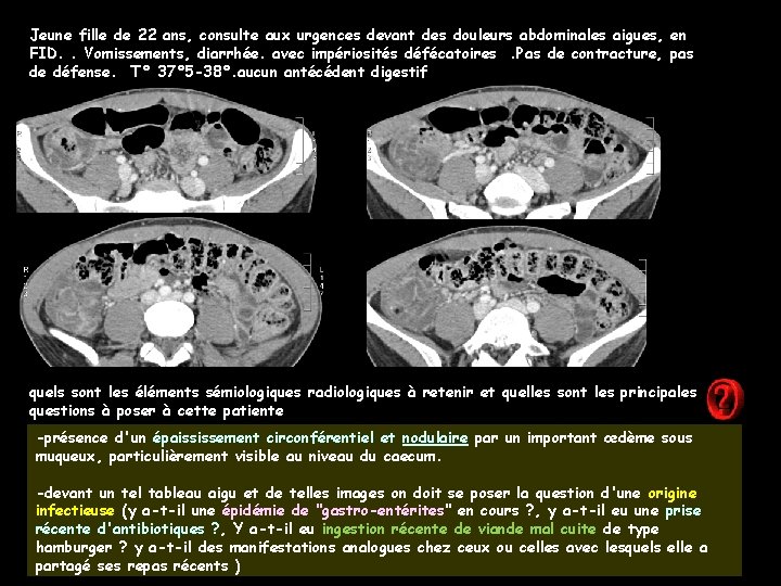 Jeune fille de 22 ans, consulte aux urgences devant des douleurs abdominales aigues, en