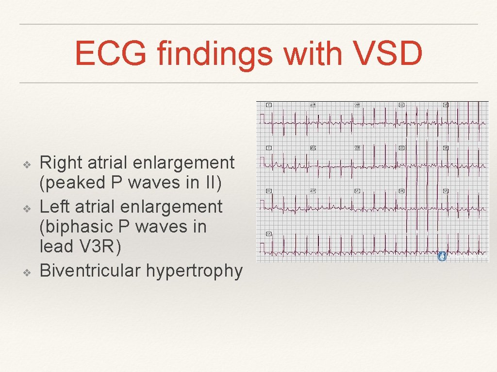 ECG findings with VSD ❖ ❖ ❖ Right atrial enlargement (peaked P waves in ECG findings with VSD ❖ ❖ ❖ Right atrial enlargement (peaked P waves in