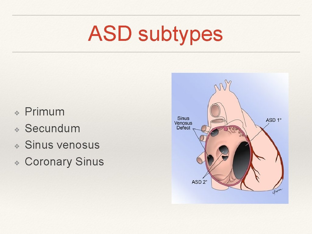 ASD subtypes ❖ ❖ Primum Secundum Sinus venosus Coronary Sinus ASD subtypes ❖ ❖ Primum Secundum Sinus venosus Coronary Sinus