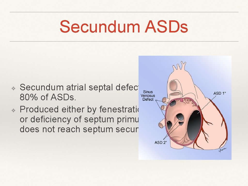 Secundum ASDs ❖ ❖ Secundum atrial septal defects account for about 80% of ASDs. Secundum ASDs ❖ ❖ Secundum atrial septal defects account for about 80% of ASDs.