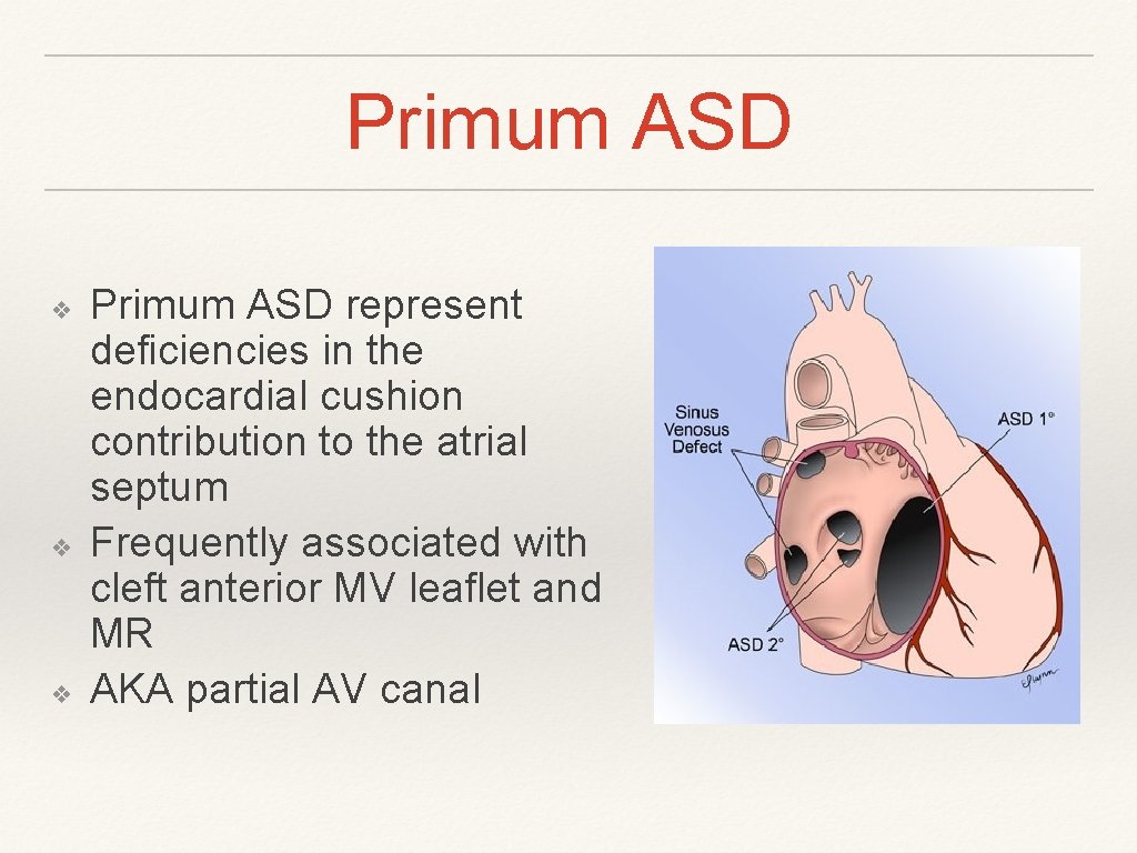 Primum ASD ❖ ❖ ❖ Primum ASD represent deficiencies in the endocardial cushion contribution Primum ASD ❖ ❖ ❖ Primum ASD represent deficiencies in the endocardial cushion contribution