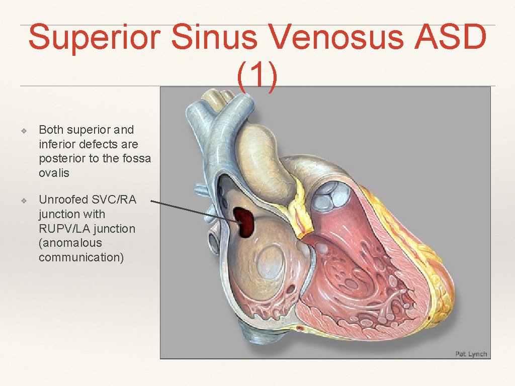 Superior Sinus Venosus ASD (1) ❖ ❖ Both superior and inferior defects are posterior Superior Sinus Venosus ASD (1) ❖ ❖ Both superior and inferior defects are posterior