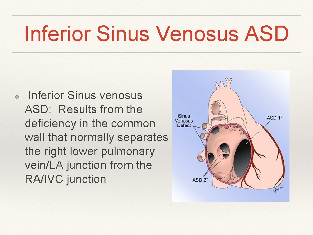 Inferior Sinus Venosus ASD ❖ Inferior Sinus venosus ASD: Results from the deficiency in Inferior Sinus Venosus ASD ❖ Inferior Sinus venosus ASD: Results from the deficiency in