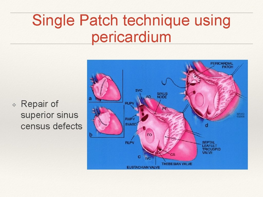 Single Patch technique using pericardium ❖ Repair of superior sinus census defects Single Patch technique using pericardium ❖ Repair of superior sinus census defects