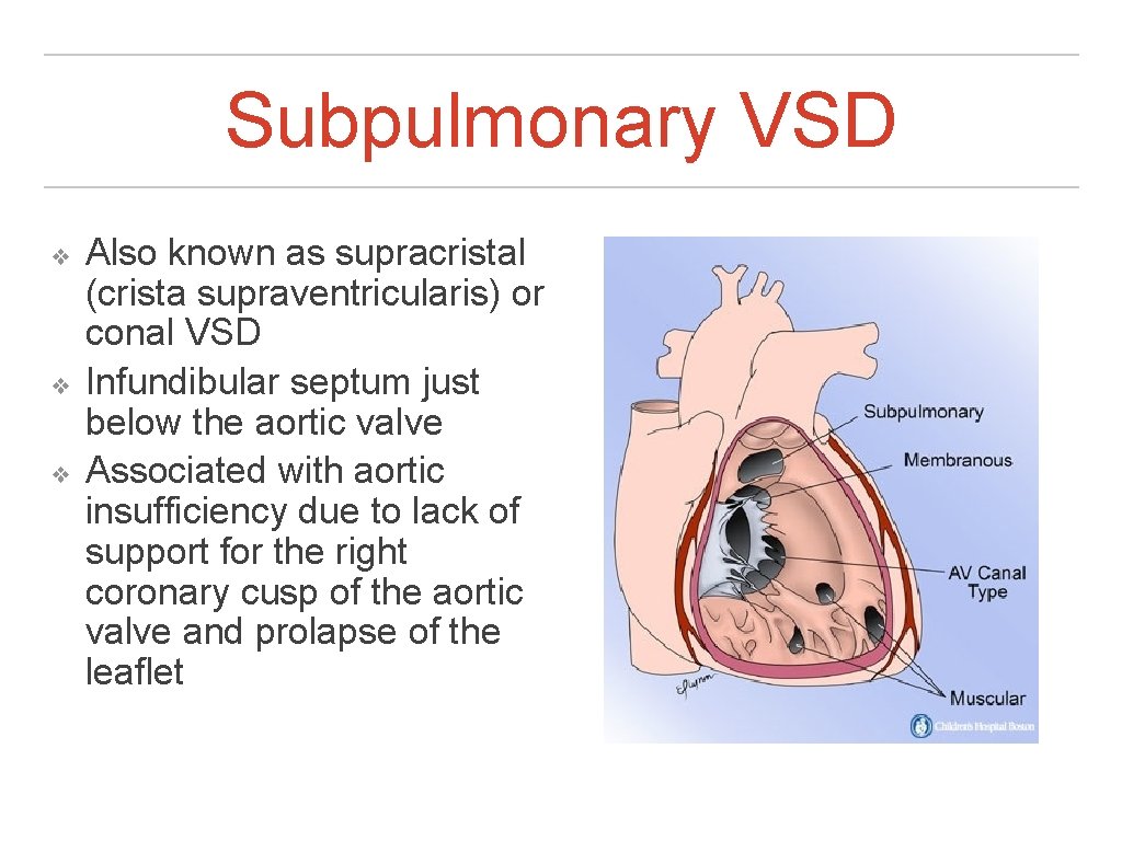 Subpulmonary VSD ❖ ❖ ❖ Also known as supracristal (crista supraventricularis) or conal VSD Subpulmonary VSD ❖ ❖ ❖ Also known as supracristal (crista supraventricularis) or conal VSD